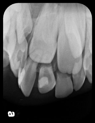 Eight hours ofter surgery I was ready to go. The nurse came in and took a temp. Stella was at 102 and would not release her till the next morning. I was not prepared for that and did not bring my tooth brush. Was going to be a long night sleeping in a chair.