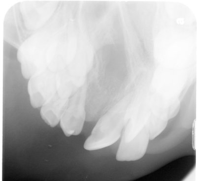 You see the light gray area on the X-Ray? That is where the bone graft would be. The point is the bone will then grow and give the roof structure.