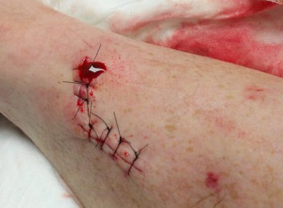 Seven Stitches Later ...