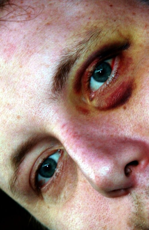 TITC - THE EYES HAVE IT...WELL THIS ONE EYE CERTAINLY GOT IT! OUCH!!!