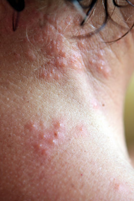 Ruths herpes zoster (shingles)
