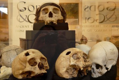 P0626 Skulls with signs of trepanation