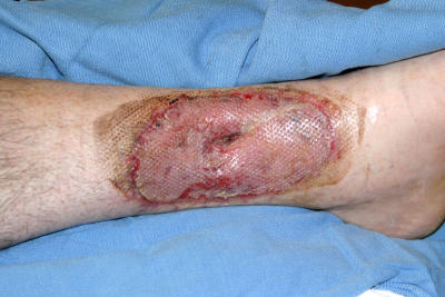 June 28 Photo 1, 9 Days After Skin Graft, 67 Days After Burn