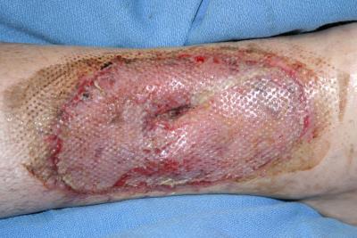 June 28 Photo 2, 9 Days After Skin Graft, 67 Days After Burn