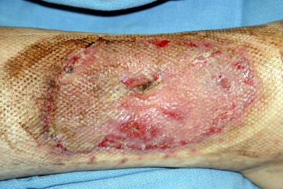 July 3 Photo 1, 14 Days After Skin Graft, 72 Days After Burn