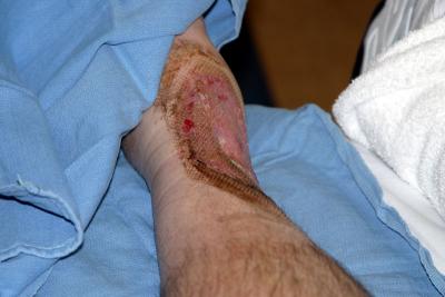 July 3 Photo 2, 14 Days After Skin Graft, 72 Days After Burn