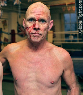 boxer broken nose bleeding.jpeg