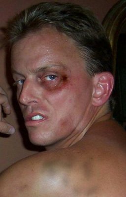 black eye bruised face boxing fighting gay man.jpg