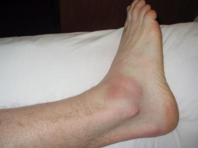 David's ankle does not look good