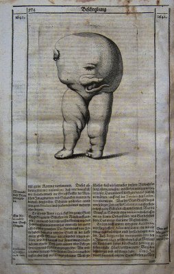 Stunted foetus