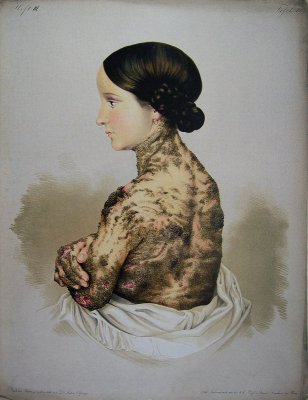 Ichtyosis hystrix