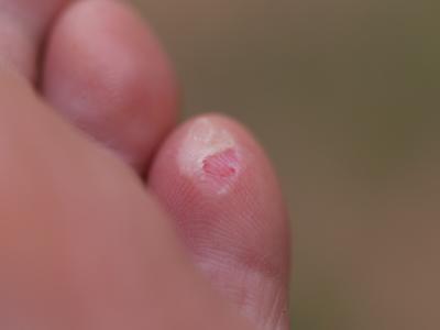 First Blister