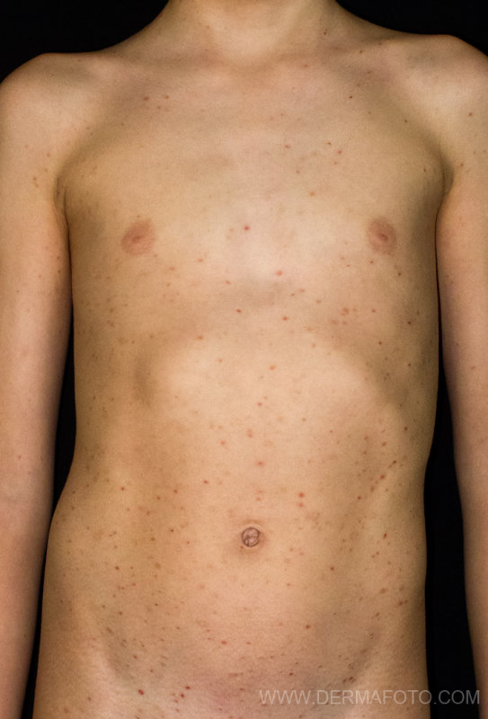 PITYRIASIS LICHENOIDES_01.jpg