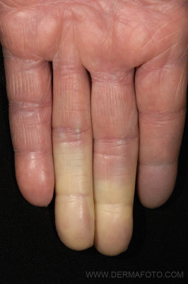 Raynaud_03.jpg