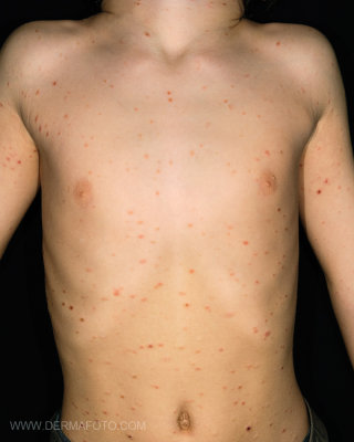 PITYRIASIS LICHENOIDES_02.JPG