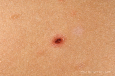 PITYRIASIS LICHENOIDES_04.jpg