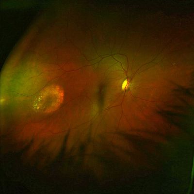 Right eye: Amelanotic choroidal nevus (optic nerve on right), Feb. 2005.