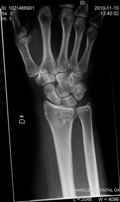 Day after radius fracture, frontal