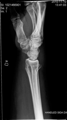 Day after radius fracture, side
