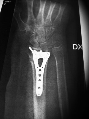 My new hardware, plate and 9 screws.