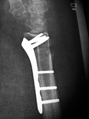 My new hardware, plate and 9 screws.
