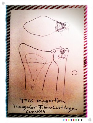 29/8 My handsurgeon IS better at surgery than drawing. Hopefully;0)