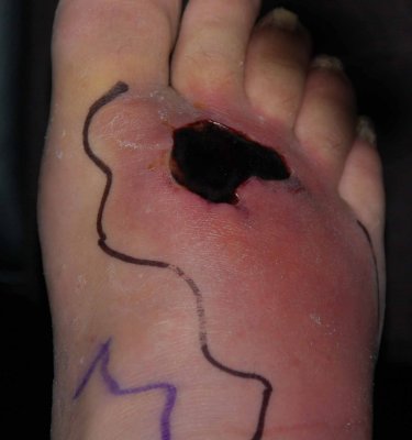 My Wrecked Foot