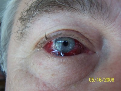 Blood vessel broke.JPG