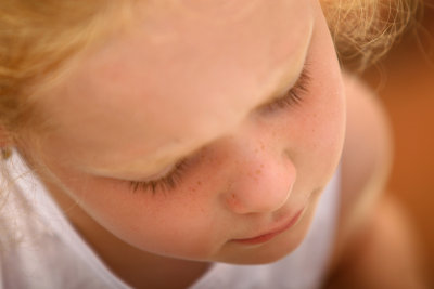 freckles