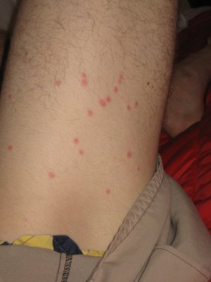 Some gnarly bug bites - these suckers itched for days.