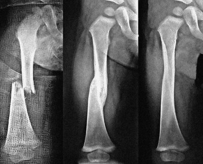 fracture-healing.jpg