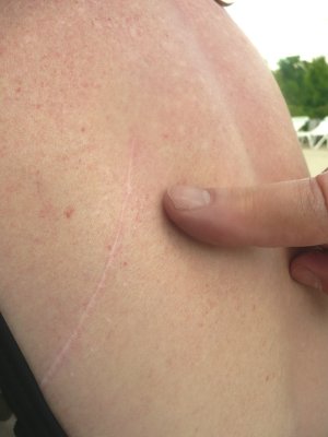 sue's old surgical scar