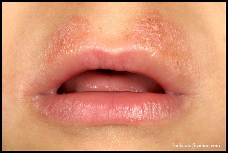 LIP-LICKING DERMATITIS.JPG