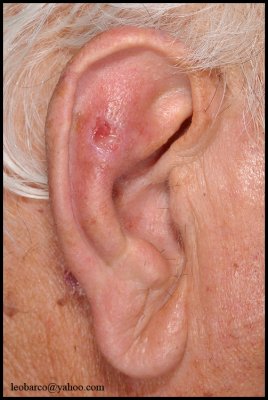 SQUAMOUS CELL CARCINOMA OF THE EAR_01.jpg