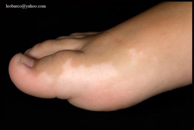 FOOT_VITILIGO