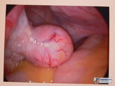 Ovarian Cysts <2cm