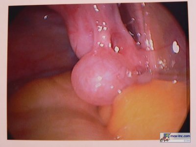 Ovarian Cysts < 2cm