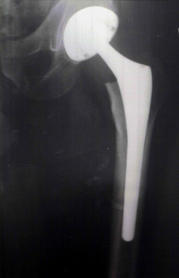 And people have the nerve to ask me, Richard, why does your leg hurt so much? I simply do not know.