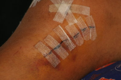 adam's tibia plateau fracture repair