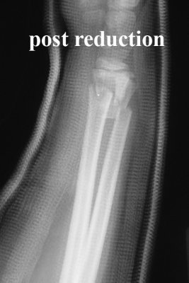post-reduction-lat