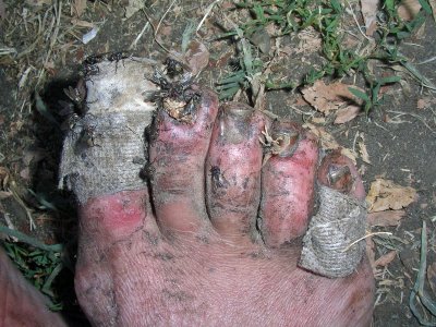 Bad Feet Of The PCT