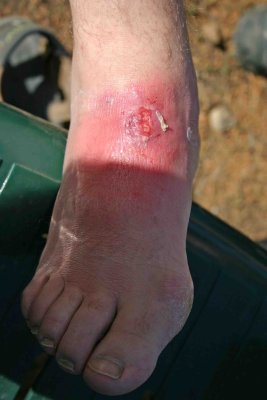  Blister Gone Bad On NoWhere Man's Foot ( Oct. 2004)