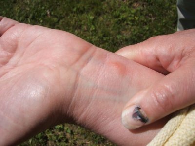 Kathy's gross thumb (car door) and poison ivy eruption