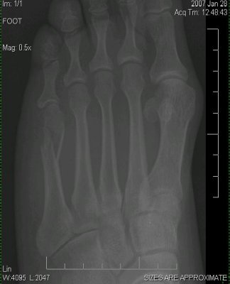Brenda's Broken Foot - Left Foot Bone - Can You See The Difference?