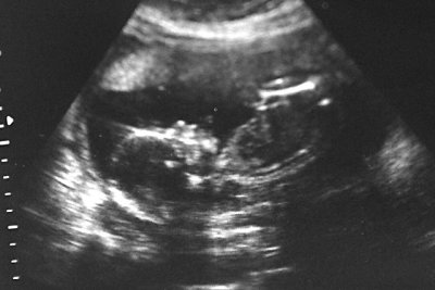 20 week ultrasound