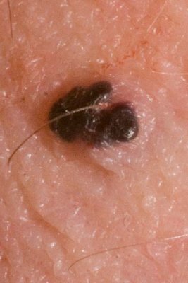 Melanoma????