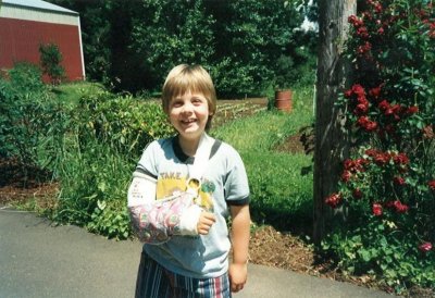 I fell off the Monkey Bars at school.  1994