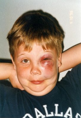 A close call... he could lost his eye.  1996