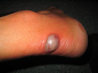 Blister from my new Vietnamese shoes