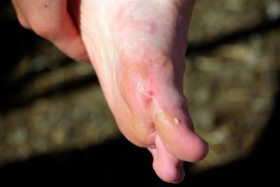 Blister pack